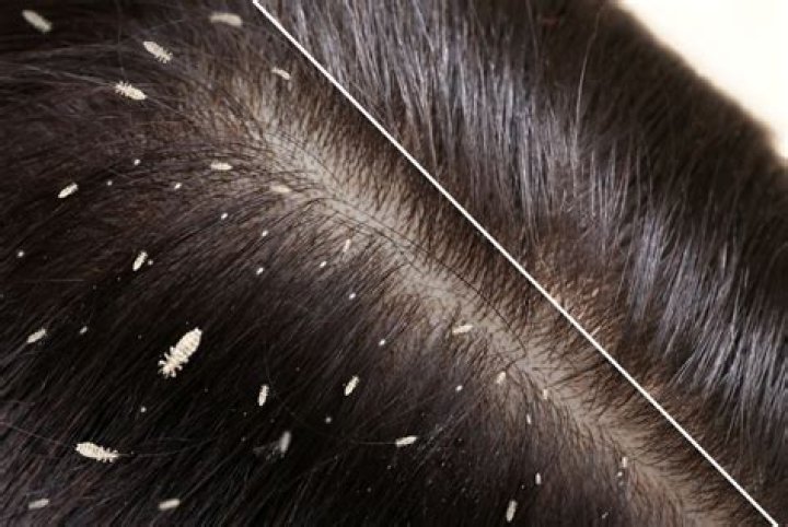 Are lice black?