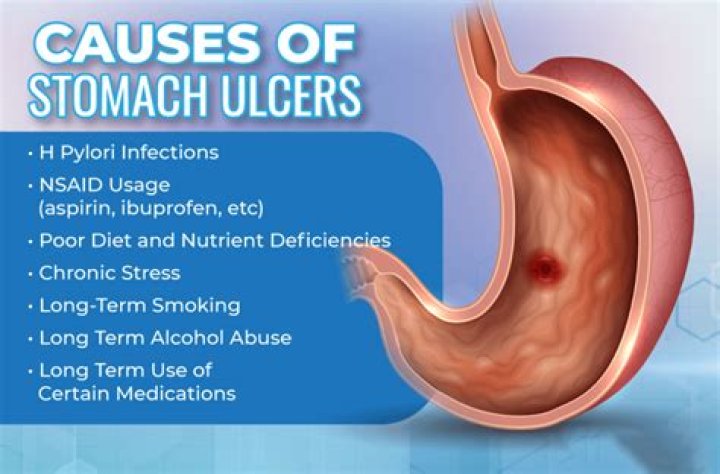 Are stomach ulcers serious?