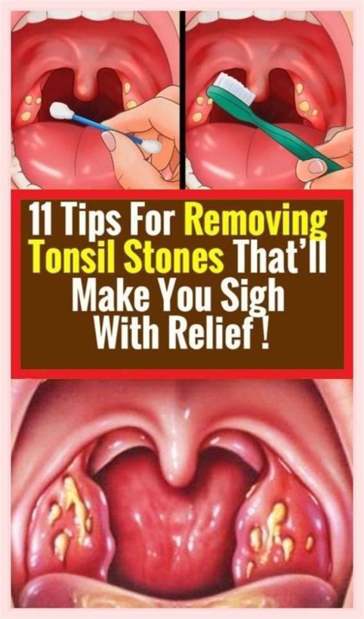 Are tonsil stones serious?