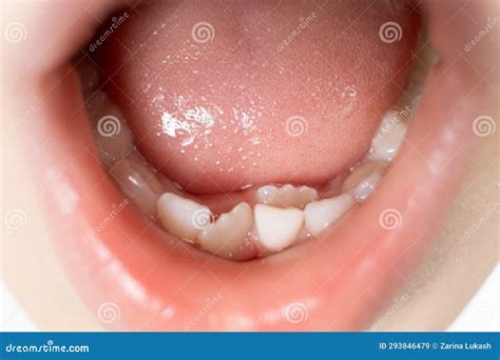 Can broken teeth grow back?