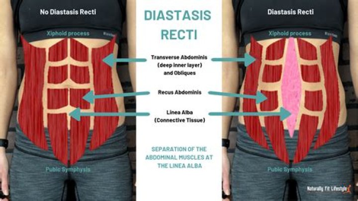 Can diastasis recti be fixed during C section?