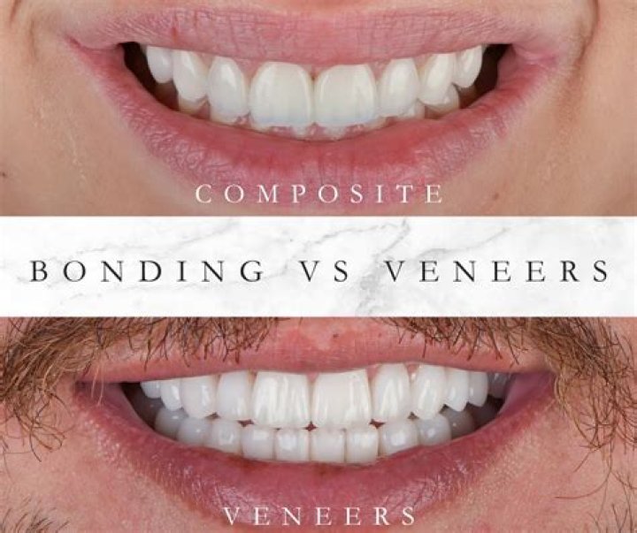 Can I use mouthwash with composite veneers?