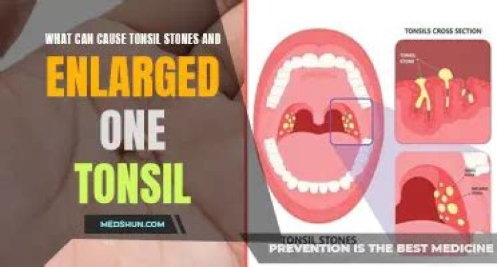 Can only one tonsil be swollen?