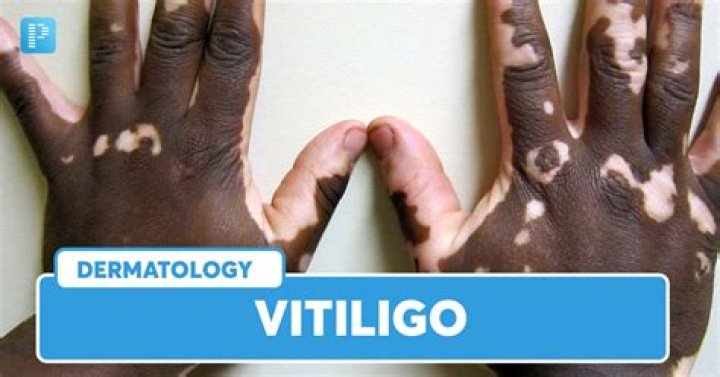 Can vitiligo appear at any age?