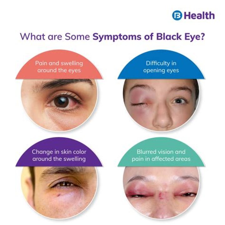 Can you get a black eye from hitting the back of your head?