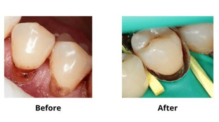 Can you scrape off tooth decay?