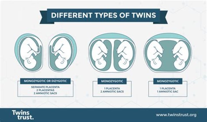 Do identical twins have different belly buttons?