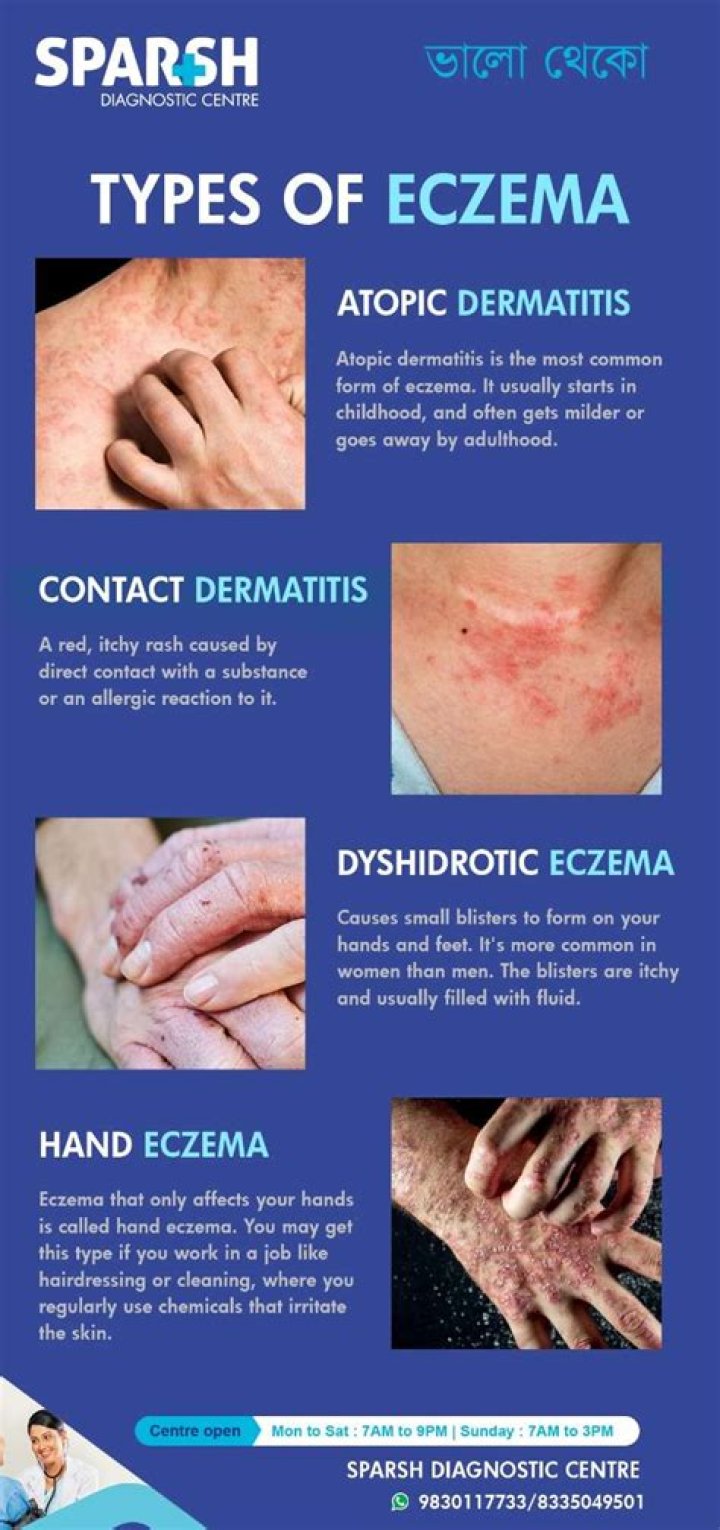 Does eczema shorten life?