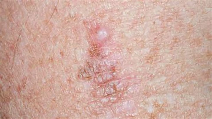 Does melanoma just appear suddenly?