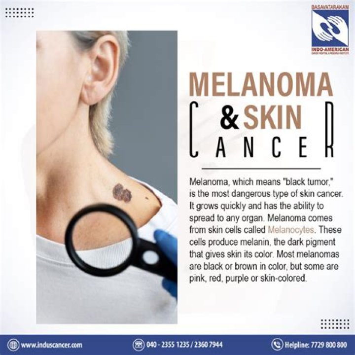 Does melanoma require chemo?
