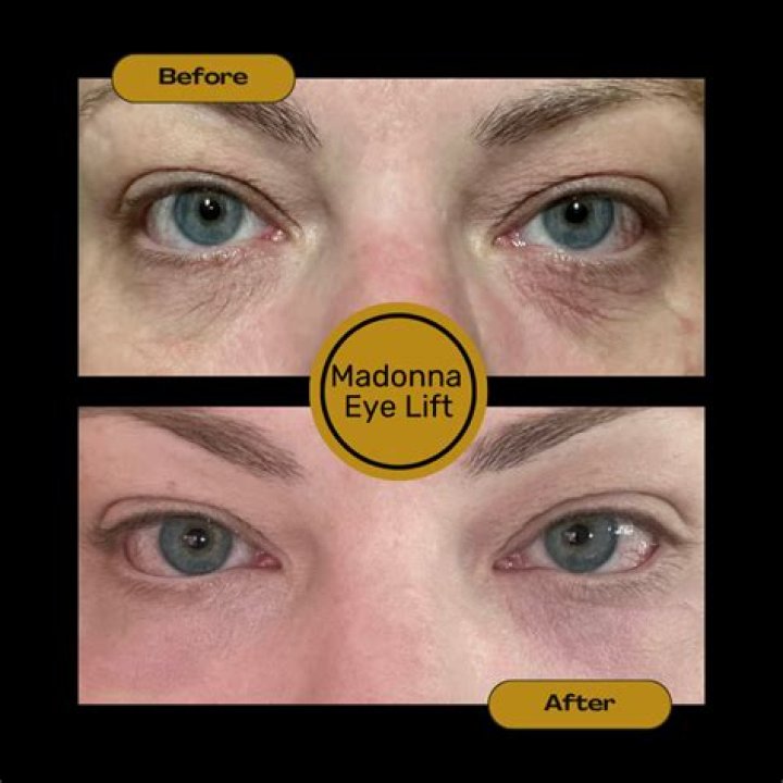 Does the Madonna eye lift work?