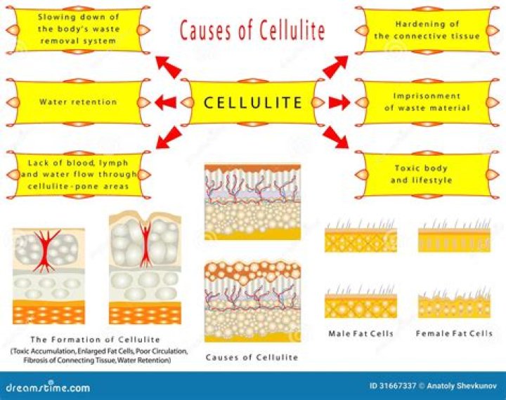Does water retention look like cellulite?