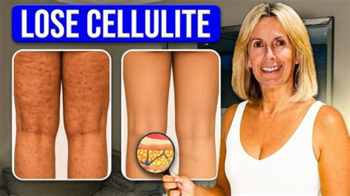 How do you get rid of cellulite after 40?