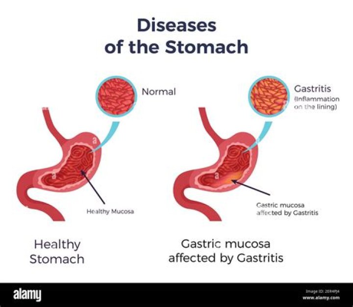 How long does it take for stomach lining to heal from gastritis?