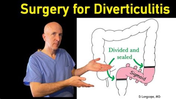How serious is surgery for diverticulitis?
