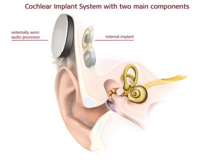 Is cochlear implant a major surgery?