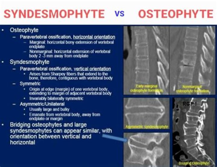 What are osteophytes in the shoulder?