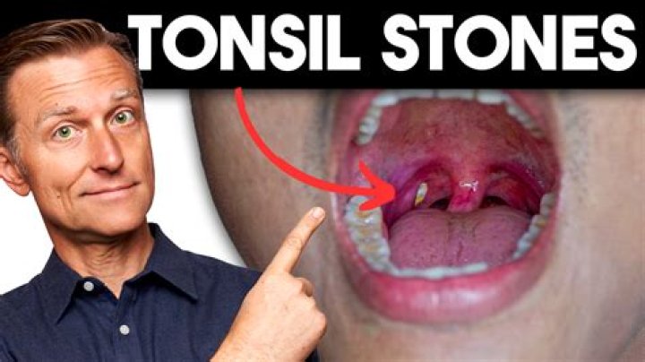 What are the cons of getting tonsils removed?