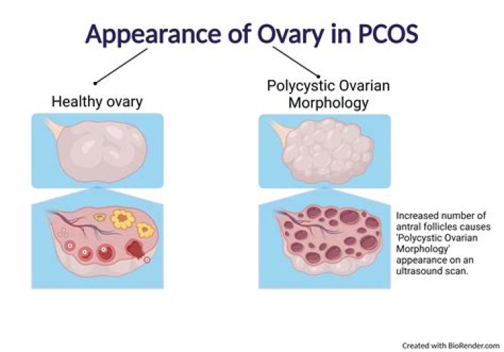 What causes ovaries to fail?
