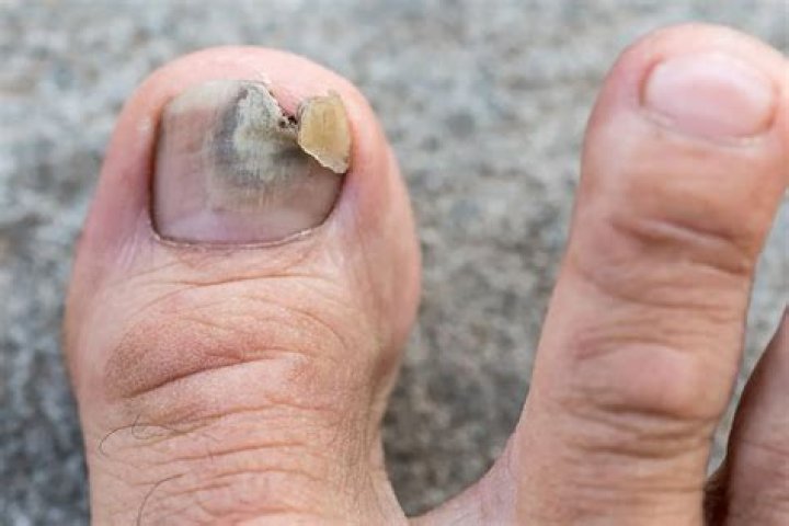 What does a grey toenail mean?