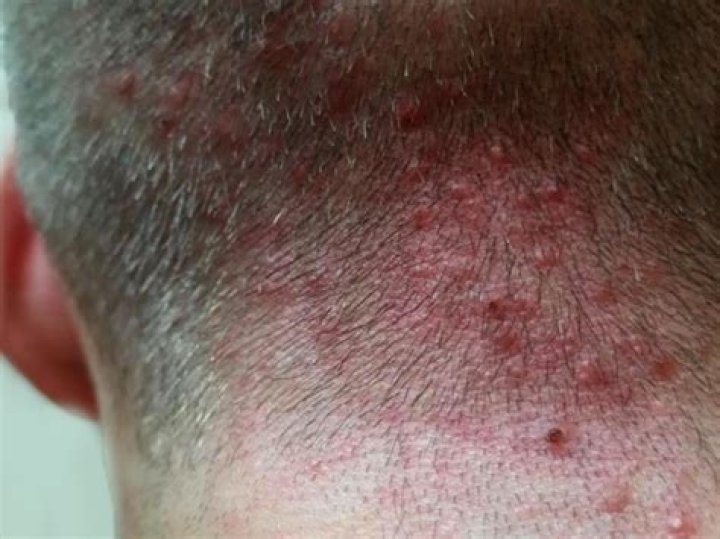 What does scalp folliculitis look like?