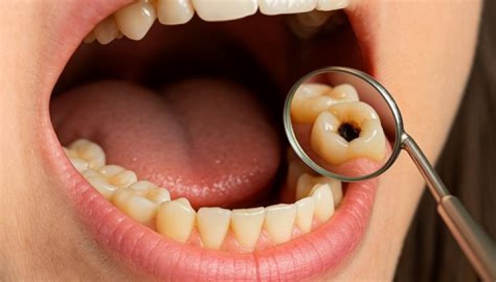 What happens if u ignore a cavity?