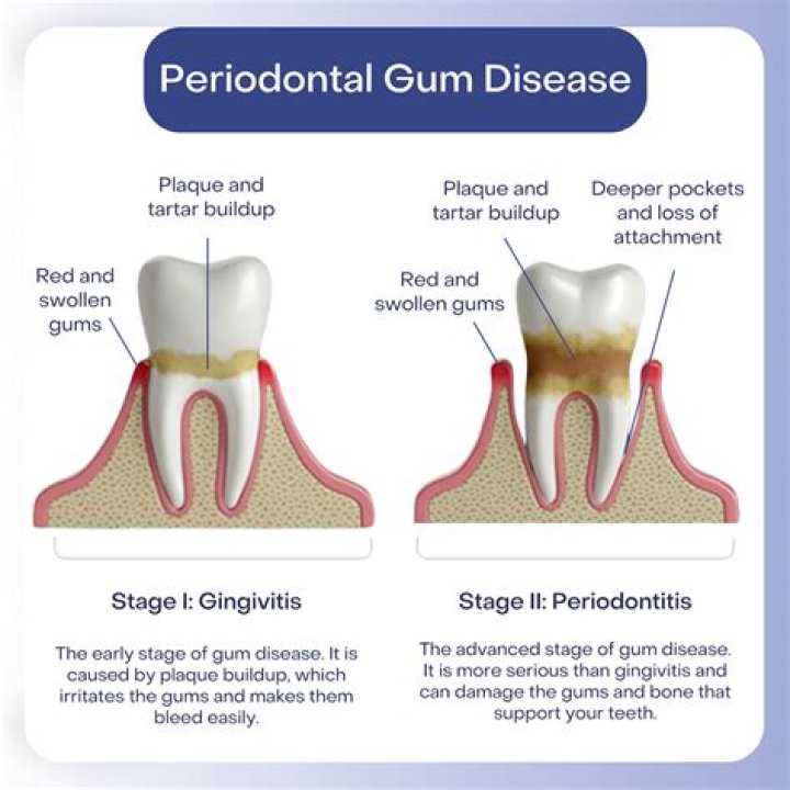 What is a periodontal abscess?