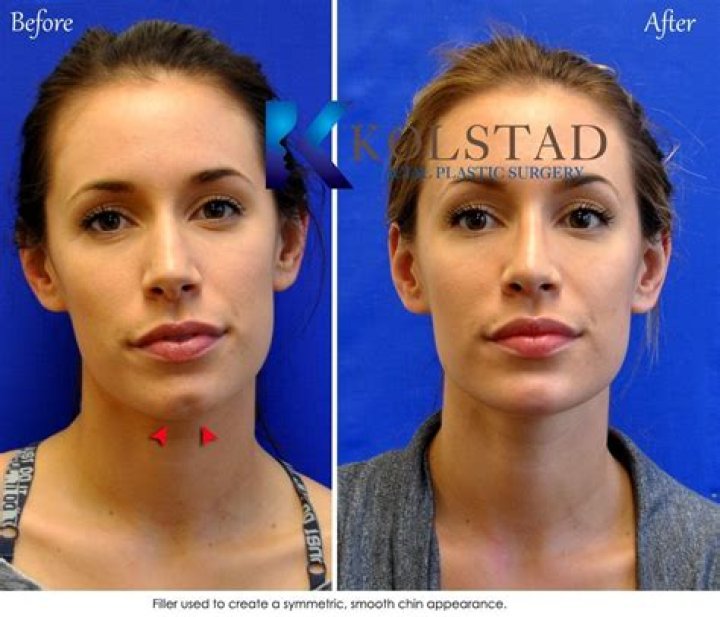 What is chin dimpling?