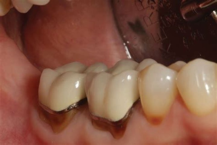 When is it too late to fill a tooth?