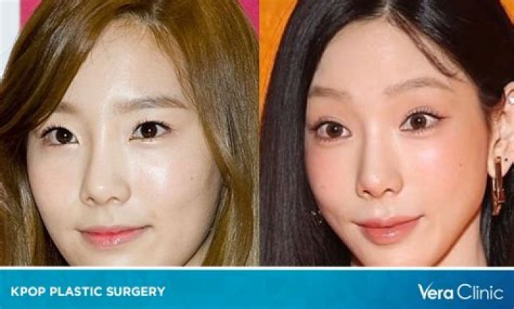 Which KPOP Idol did plastic surgery?