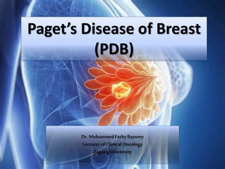 Who gets Paget's disease of the breast?