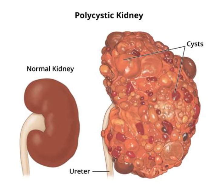 Why do people get cysts?
