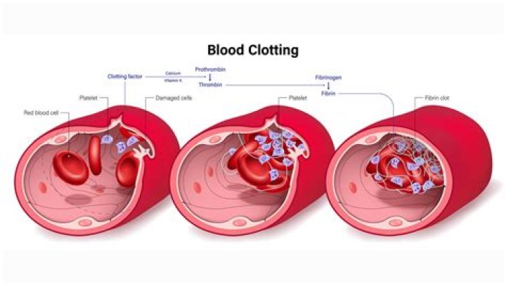 Why does bed rest cause blood clots?