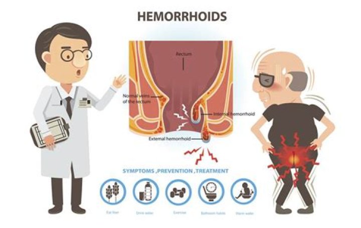 Will external hemorrhoids go away?