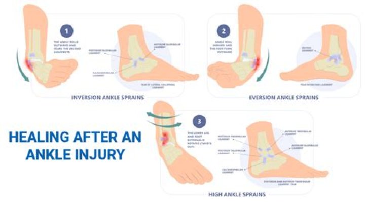 Will my ankle ever be the same after a sprain?